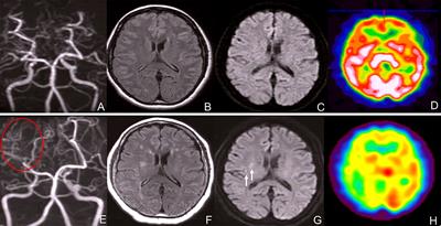 Case Report: A Case of Moyamoya Syndrome Associated With Multiple Endocrine Neoplasia Type 2A